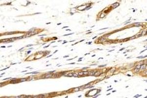 Immunohistochemistry analysis of paraffin-embedded human liver cancer using Integrin alpha V (ABIN7074314) at dilution of 1: 500