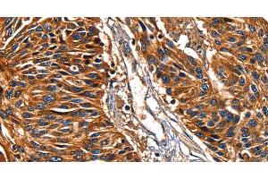 Immunohistochemistry of paraffin-embedded Human esophagus cancer tissue using Galectin 8 Polyclonal Antibody at dilution 1:50 (LGALS8 anticorps)