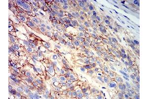 Immunohistochemical analysis of paraffin-embedded esophageal cancer tissues using CD147 mouse mAb with DAB staining.
