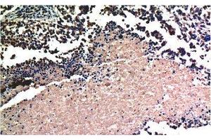 Immunohistochemistry of paraffin-embedded Human lung carcinoma tissue using AKT1 Monoclonal Antibody at dilution of 1:200. (AKT1 anticorps)