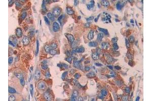 DAB staining on IHC-P; Samples: Human Breast cancer Tissue