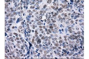 Immunohistochemical staining of paraffin-embedded Adenocarcinoma of colon tissue using anti-L1CAMmouse monoclonal antibody. (L1CAM anticorps)