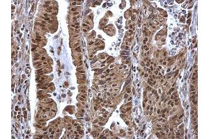 IHC-P Image SP1 antibody detects SP1 protein at nucleus on human gastric carcinoma by immunohistochemical analysis.