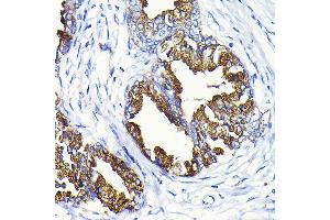 Immunohistochemistry of paraffin-embedded human prostate cancer using KLK3 Rabbit pAb (ABIN3022794, ABIN3022795, ABIN3022796 and ABIN6219231) at dilution of 1:100 (40x lens). (Prostate Specific Antigen anticorps  (AA 1-100))