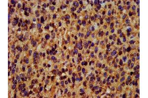 IHC image of ABIN7173439 diluted at 1:400 and staining in paraffin-embedded human glioma performed on a Leica BondTM system. (TRIM35 anticorps  (AA 1-206))