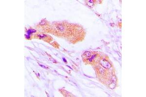 Immunohistochemical analysis of MMP1 staining in human lung cancer formalin fixed paraffin embedded tissue section.