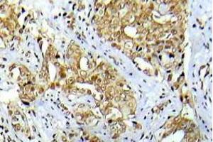 Immunohistochemistry analysis Phospho-Abl1 antibody in paraffin-embedded human breast carcinoma tissue. (ABL1 anticorps  (pTyr412))
