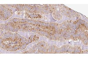 ABIN6267093 at 1/100 staining Human thyroid cancer tissue by IHC-P. (ATG13 anticorps  (pSer355))