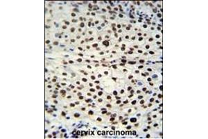 HNRB Antibody (N-term) (ABIN651713 and ABIN2840371) immunohistochemistry analysis in formalin fixed and raffin embedded human cervix carcinoma followed by peroxidase conjugation of the secondary antibody and DAB staining. (HNRNPAB anticorps  (N-Term))