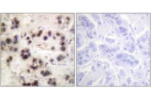 Immunohistochemistry analysis of paraffin-embedded human breast carcinoma, using p63 (Phospho-Ser455) Antibody.