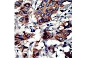 Formalin-fixed and paraffin-embedded human cancer tissue reacted with the primary antibody, which was peroxidase-conjugated to the secondary antibody, followed by AEC staining.