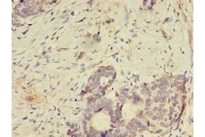 Immunohistochemistry of paraffin-embedded human gastric cancer using ABIN7166144 at dilution of 1:100 (SPIRE2 anticorps  (AA 79-388))