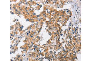 Immunohistochemistry of Human gastric cancer using CHMP1A Polyclonal Antibody at dilution of 1:60 (CHMP1A anticorps)