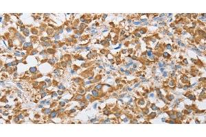 Immunohistochemistry of paraffin-embedded Human thyroid cancer tissue using CENPO Polyclonal Antibody at dilution 1:40 (CENPO anticorps)