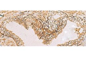 Immunohistochemistry of paraffin-embedded Human prost ate cancer tissue using RAB38 Polyclonal Antibody at dilution of 1:60(x200)