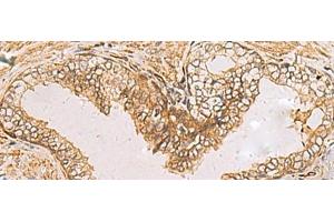 Immunohistochemistry of paraffin-embedded Human prost ate cancer tissue using RAB38 Polyclonal Antibody at dilution of 1:60(x200) (RAB38 anticorps)
