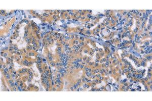 Immunohistochemistry of paraffin-embedded Human thyroid cancer tissue using DOK4 Polyclonal Antibody at dilution 1:50