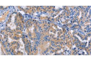 Immunohistochemistry of paraffin-embedded Human thyroid cancer tissue using DOK4 Polyclonal Antibody at dilution 1:50 (DOK4 anticorps)