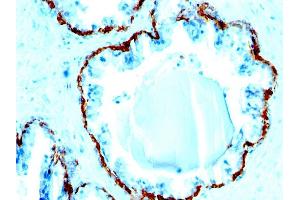 Formalin-fixed, paraffin-embedded human Prostate Carcinoma stained with Cytokeratin, HMW Monoclonal Antibody (SPM591). (Keratin Basic anticorps)