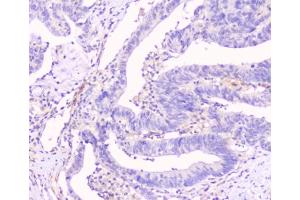 IHC testing of human intestinal cancer tissue with Cx43 antibody at 1ug/ml.