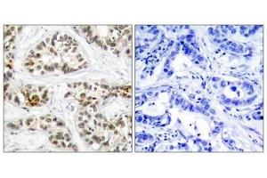 Immunohistochemical analysis of paraffin-embedded human breast carcinoma tissue using RelB(Phospho-Ser573) Antibody(left) or the same antibody preincubated with blocking peptide(right). (RELB anticorps  (pSer573))