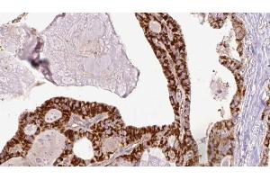 ABIN6267205 at 1/100 staining Human thyroid cancer tissue by IHC-P.
