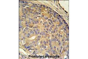 LOH12CR1 Antibody immunohistochemistry analysis in formalin fixed and paraffin embedded human prostate carcinoma followed by peroxidase conjugation of the secondary antibody and DAB staining. (LOH12CR1 anticorps  (C-Term))