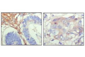 Immunohistochemical analysis of paraffin-embedded human colon cancer (left) and breast cancer (right) showing cytoplasmic localization with DAB staining using FBLN5 mouse mAb.