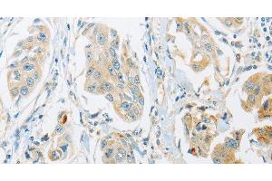 Immunohistochemistry of paraffin-embedded Human breast cancer tissue using ARHGEF10 Polyclonal Antibody at dilution 1:45 (ARHGEF10 anticorps)