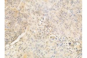 ABIN6259146 and ABIN6273735 at 1/100 staining human esophageal carcinoma by IHC-P. (PAX4 anticorps  (Internal Region))