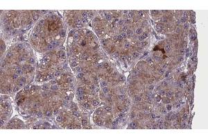 ABIN6273983 at 1/100 staining Human liver cancer tissue by IHC-P. (OR2T6 anticorps  (C-Term))