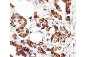 IHC analysis of FFPE human breast carcinoma section using INSRR antibody; Ab was diluted at 1:25. (INSRR anticorps  (AA 668-702))