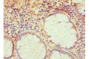 Immunohistochemistry of paraffin-embedded human colon cancer using ABIN7143276 at dilution of 1:100 (TRAF3IP2 anticorps  (AA 1-300))