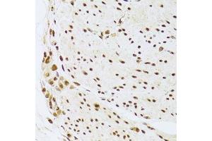 Immunohistochemistry of paraffin-embedded human gastric cancer using ANP32A Antibody.