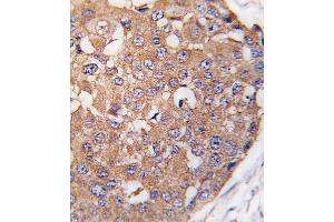 Formalin-fixed and paraffin-embedded human breast carcinoma tissue reacted with SNK Antibody (C-term ) (ABIN391375 and ABIN2841386) , which was peroxidase-conjugated to the secondary antibody, followed by DAB staining. (PLK2 anticorps  (C-Term))