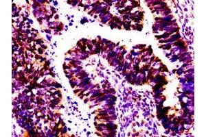 IHC image of ABIN7155808 diluted at 1:100 and staining in paraffin-embedded human ovarian cancer performed on a Leica BondTM system.