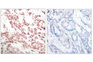 Immunohistochemical analysis of paraffin- embedded human breast carcinoma tissue using NF-κ,B p100 (phospho- ser866) antibody.