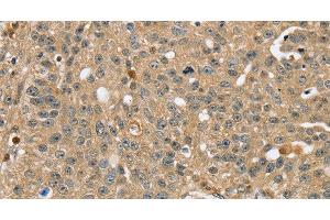 Immunohistochemistry of paraffin-embedded Human breast cancer using RNH1 Polyclonal Antibody at dilution of 1:40 (RNH1 anticorps)