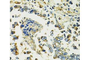 Immunohistochemistry of paraffin-embedded Human colon carcinoma using SLC25A11 Polyclonal Antibody at dilution of 1:100 (40x lens). (SLC25A11 anticorps)