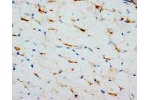 Immunohistochemical analysis of paraffin-embedded rectal carcinoma sections, stain GJA1 in cytoplasm DAB chromogenic reaction. (Connexin 43/GJA1 anticorps  (C-Term))
