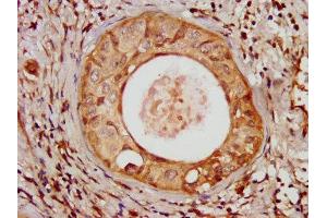 IHC image of ABIN7175108 diluted at 1:100 and staining in paraffin-embedded human cervical cancer performed on a Leica BondTM system. (UMPS anticorps  (AA 314-444))