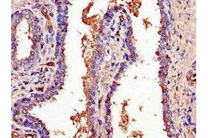 Immunohistochemistry of paraffin-embedded human prostate cancer using ABIN7164882 at dilution of 1:100 (PCOTH anticorps  (AA 50-100))