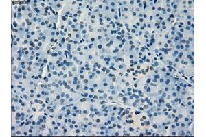 Immunohistochemical staining of paraffin-embedded Adenocarcinoma of breast tissue using anti-IRF3 mouse monoclonal antibody. (IRF3 anticorps)