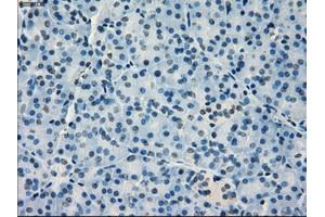 Immunohistochemical staining of paraffin-embedded Adenocarcinoma of breast tissue using anti-IRF3 mouse monoclonal antibody. (IRF3 anticorps)