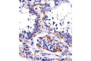 (ABIN390207 and ABIN2840690) staining DDIT4 in human lung adenocarcinoma tissue sections by Immunohistochemistry (IHC-P - paraformaldehyde-fixed, paraffin-embedded sections). (DDIT4 anticorps  (N-Term))
