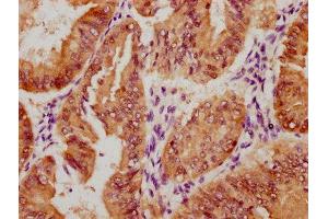 IHC image of ABIN7127761 diluted at 1:100 and staining in paraffin-embedded human endometrial cancer performed on a Leica BondTM system.