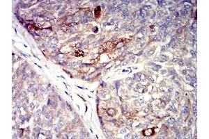 Immunohistochemical analysis of paraffin-embedded bladder cancer tissues using P2RY4 mouse mAb with DAB staining.