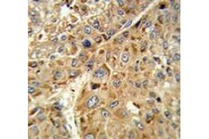 Immunohistochemistry analysis of human hepatocarcinoma tissue (Formalin-fixed, Paraffin-embedded) using Glutathione peroxidase 1 / GPX1  Antibody (C-term), followed by peroxidase-conjugated secondary antibody and DAB staining. (Glutathione Peroxidase 1 anticorps  (C-Term))