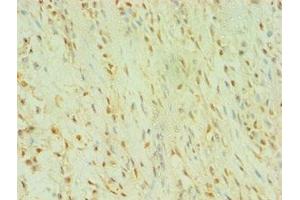 Immunohistochemistry of paraffin-embedded human breast cancer using ABIN7174010 at dilution of 1:100 (BLK anticorps  (AA 1-280))