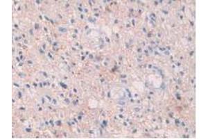 IHC-P analysis of Human Glioma Tissue, with DAB staining. (HIF1A anticorps  (AA 218-506))